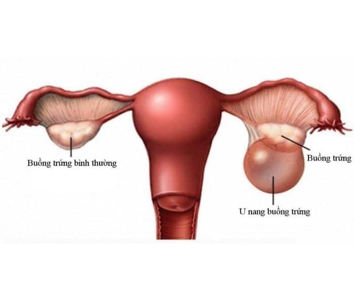 Bệnh phụ khoa phổ biến như nhiễm trùng âm đạo, viêm âm đạo, u nang buồng trứng đều có thể dẫn tới tiểu nhỏ giọt ở nữ 