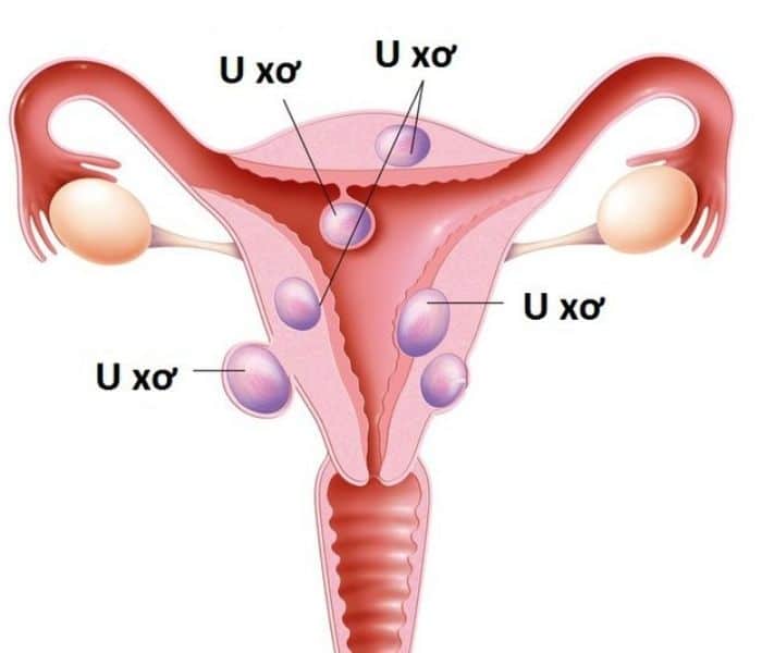 U xơ tử cung, u nang buồng trứng gây ra đái đau rát, đái buốt, đái rắt sau quan hệ ở nữ giới