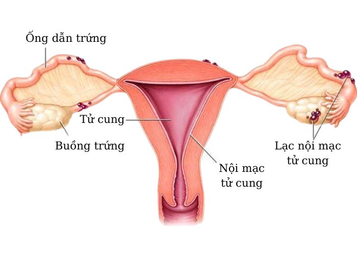 Lạc nội mạc tử cung gây tiểu ra máu ở phụ nữ