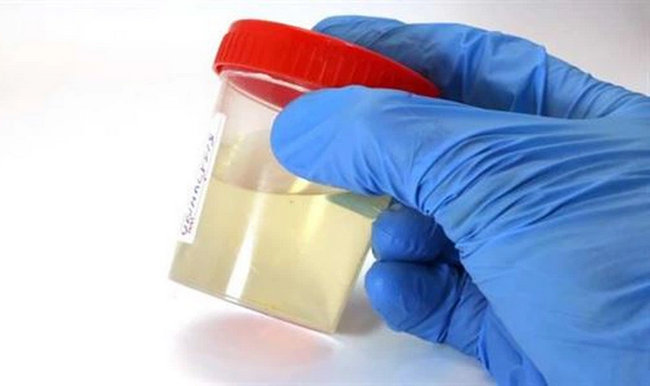 nuoc tieu mau duc la lam sao