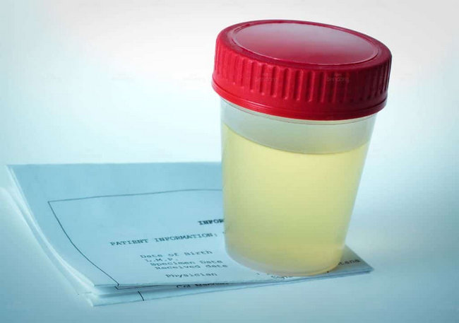 nuoc tieu co mau duc la benh gi