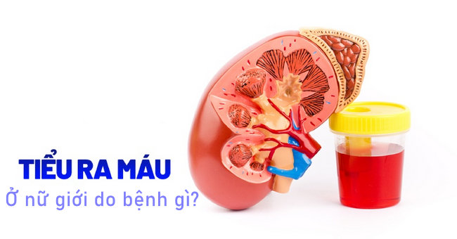 Tiểu ra máu ở nữ có thể do những nguyên nhân nào gây nên?