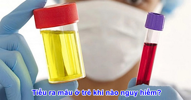 tieu ra mau o tre khi nao nguy hiem