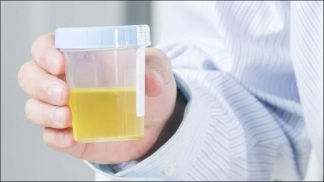 buoc tieu mau vang binh thuong khi nao