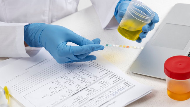 nhan biet nuoc tieu mau vang khi nao bat thuong va binh thuong