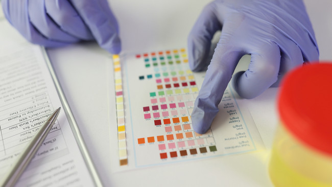 Vì sao Nước tiểu ban đêm thường đậm màu