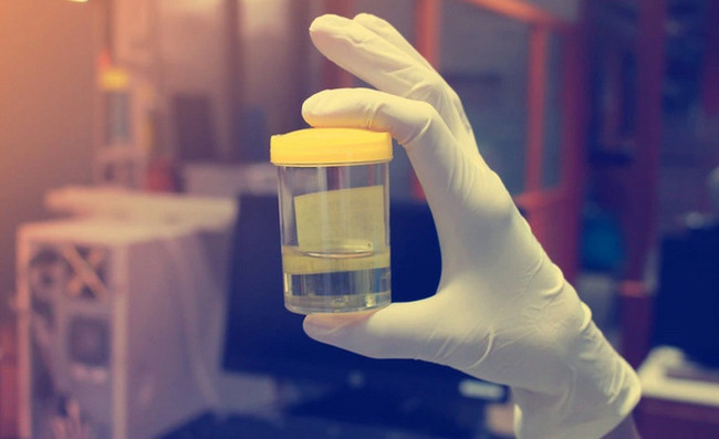 Nước tiểu màu xanh là do thực phẩm hay thuốc