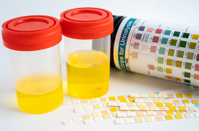 trẻ em có nước tiểu màu lạ