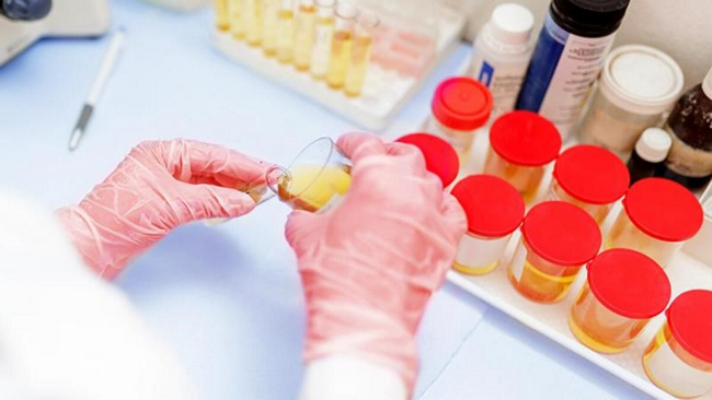 Cần làm xét nghiệm gì khi nước tiểu đỏ