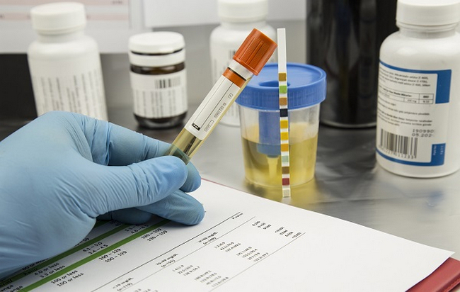 các xét nghiệm cần làm khi thấy nước tiểu màu đỏ